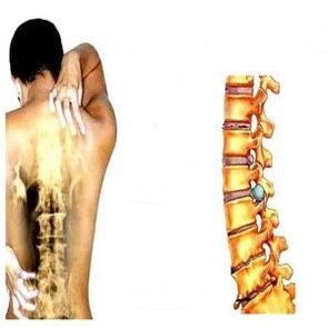 Osteochondrozės etapai