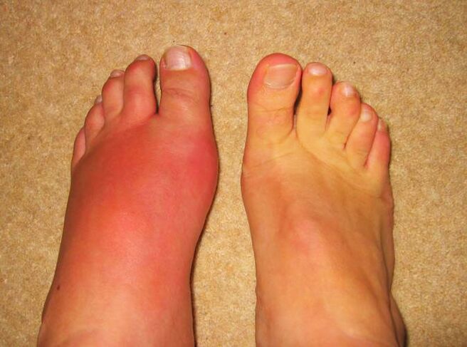 kojų sąnarių skausmas dėl podagros